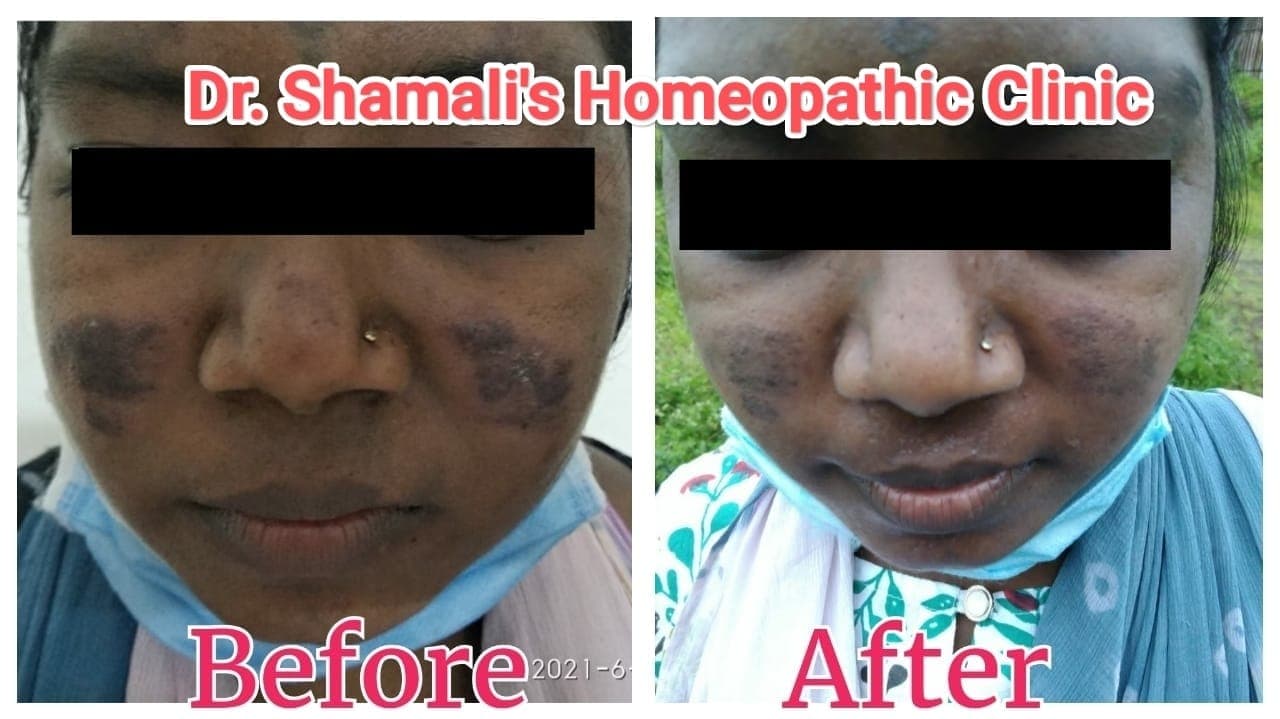 Before and after skin improvement with homoeopathic care